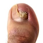 Fungal nail infection 