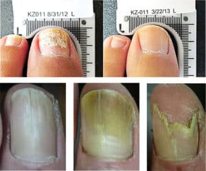 Lunula cold laser treatment fungal nail infection results