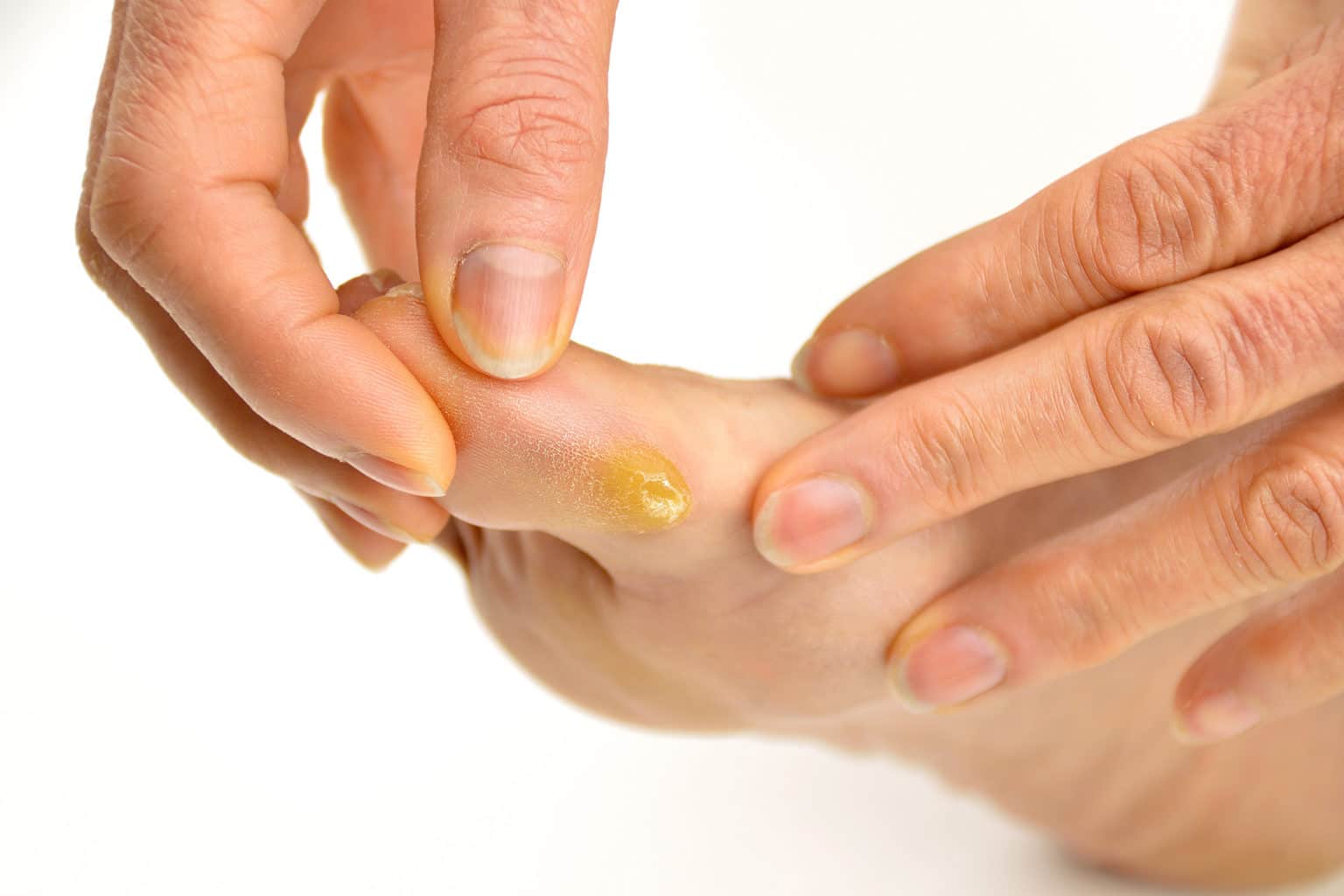 The difference between corns and calluses Waverley Foot Clinic